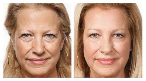 PRP Injections Before & After Pictures .